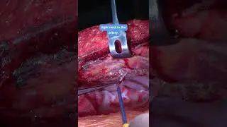 Cox-MAZE IV with Coronary Artery Bypass Graft (CABG) and Mitral Valve Replacement (MVR) #resident