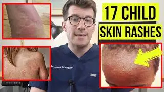 Identifying SKIN RASHES in BABIES and CHILDREN | DOCTOR explains 17 COMMON SKIN CONDITIONS