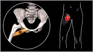 Sore groin and thigh. Comb muscle and myofascial pain syndrome