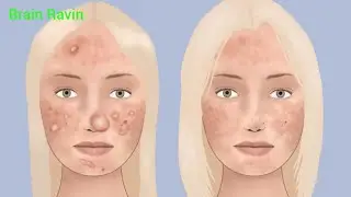 Asmr / juicy acne popping & cyst draining 