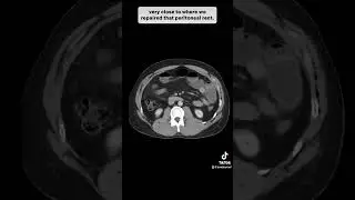 CT Scan for a Small Bowel Obstruction 