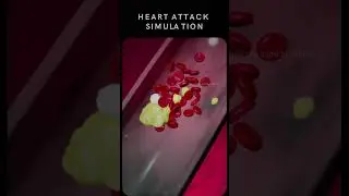 Heart Attack Online Simulation - 3D Animation