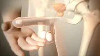 penis protez tek parçalı animasyon