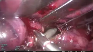 laparoskopik kist hidatik ameliyatı(laparoscopic cyst hydatid surgery)