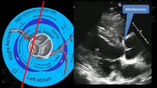 A/Prof Greg Scalia: Imaging the aortic valve