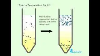 Sperm Preperation For IUI