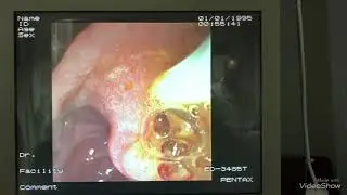 Ercp ile kist hidatik çıkarılması. Entfernung einer Hydatidzyste mit Ercp. Hydatidzyste