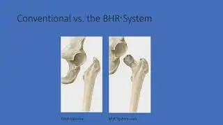 Hip Resurfacing and Management of Arthritis in Young Patients: Wayne Colizza, MD