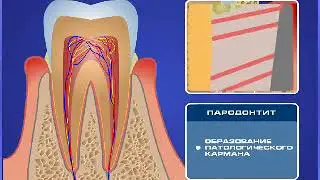 Развитие парадонтита - 1