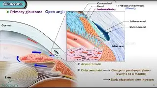 Primary Glaucoma 👁 : Ophthalmology Lecture