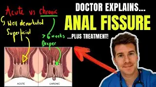 Doctor explains ANAL FISSURE, including causes, classification and treatment options