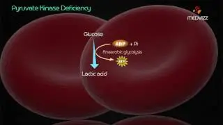 Pyruvate kinase deficiency