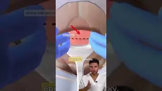 КЕСАРЕВО СЕЧЕНИЕ: какие есть минусы? 