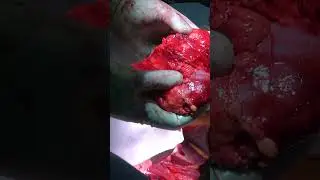 Resecting the Tumor during a Leiomyosarcoma of Inferior Vena Cava #medicine #learn #doctor #medical