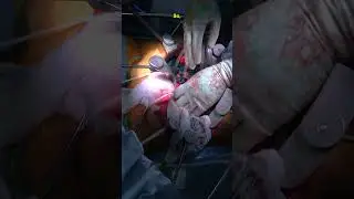 Mid-Surgery Review : Leiomyosarcoma of Inferior Vena Cava: Resection and Reconstruction #medicine