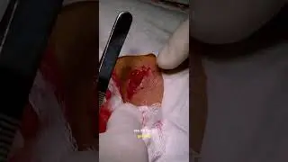 Pediatric Surgical Treatment of a Wrist Ganglion Cyst in a Resource-Limited Setting #medicine #learn