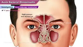 Acute Bacterial Rhinosinusitis 👃 (ABRS) : ENT Lectures