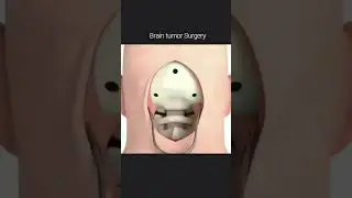 Brain Tumor Removal 👍 An overview how to remove brain tumor surgery ✅