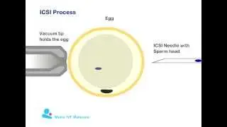 Icsi process during IVF cycle