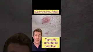 Part 2: SUPERNUMERARY NIPPLE AKA THIRD NIPPLE EXPLAINED 