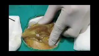 Pilonidal Cyst Abcess - Apseli KDS