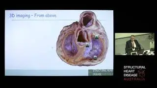 Imaging the Tricuspid Valve - Prof Greg Scalia