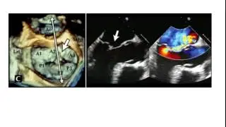 Dr Jason Kaplan: 3D Echocardiographic Assessment of Mitral Valve Disease