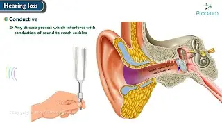 Conductive Hearing loss 🦻🔊: ENT Lecture