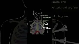 Key Steps for a “Robotic Thymectomy for Myasthenia Gravis #medicine #learn #doctor #surgeon #anatomy