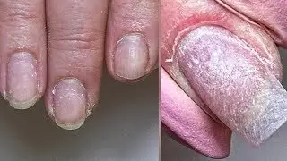 Problematic Cuticle / Complex Manicure