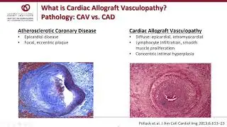 Cardiac Allograft Vasculopathy (CAV) - Weekly Research Conference with Sharon Chih, MD, PhD