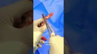 Chest Tube Placement for Possible Hemothorax #medicine #medical #surgeon #doctor #learn #technique