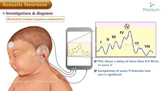 Acoustic Neuroma : ENT Lectures