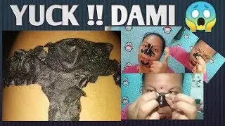 WHITEHEADS/BLACK HEADS REMOVAL , YUCK!DAMI 😱😱