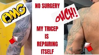 Tricep Is Back | No Surgery | My Torn Tricep Fixed Itself