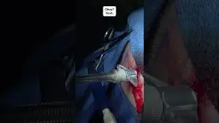 Emergent Right Frontal Camino Bolt Placement for Intracranial Pressure Monitoring for a GCS Under 8