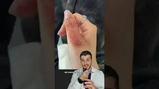 La ragazza che ha curato perfettamente l'ustione sul dito⚠️ 