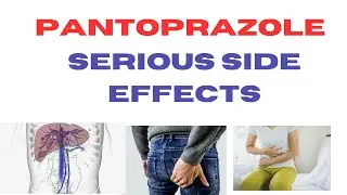 What are the serious side effects of Pantoprazole? Natural alternatives to pantoprazole?