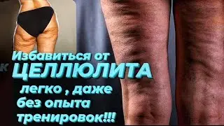 Избавиться от ЦЕЛЛЮЛИТа! лечение, диета, крем, средства, упражнения