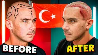 I Got a Hair Transplant in Turkey: The Ultimate Guide